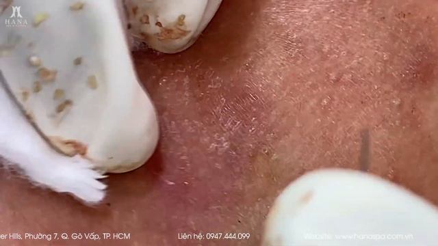 Извлечение угрей и прыщей. Черные точки. Удаление угрей и выдавливание прыщей на лице и теле.