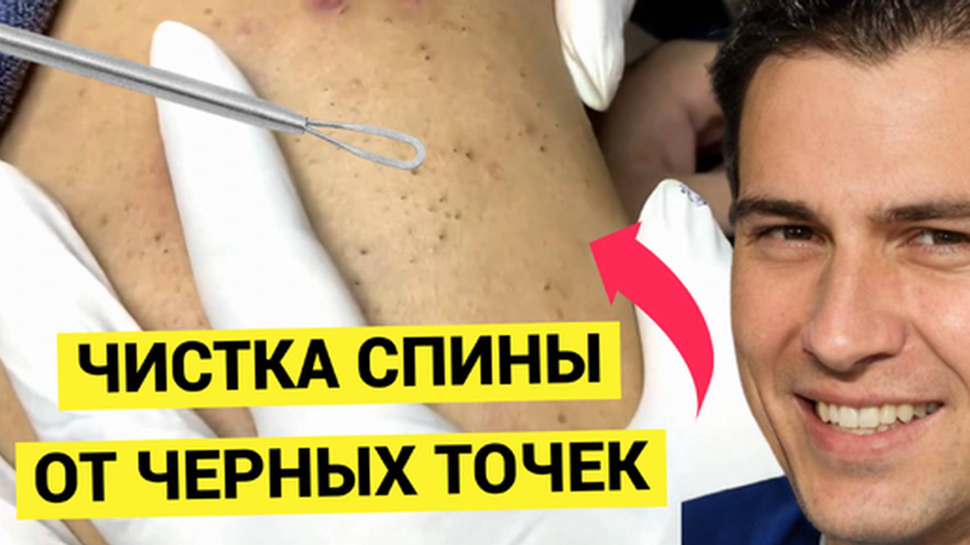 Очистка спины от Угрей и Жировиков. Мастер был неряшлив и допустил много ошибок(1)