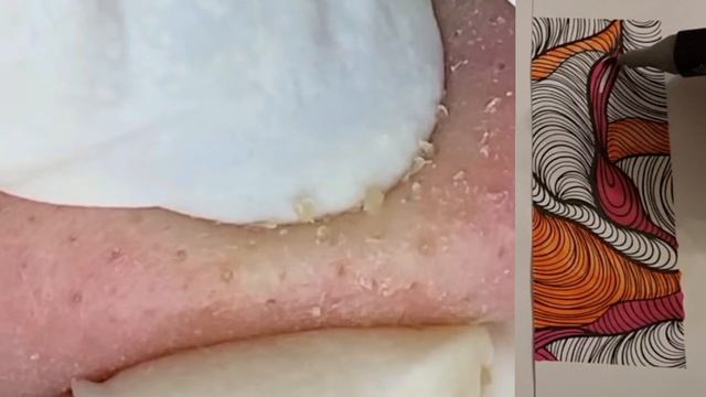 Механическая чистка пор