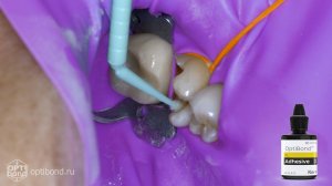 #Optibond application to occlusial surfaces of tooth  36 #purplerubberdam #rubberdamology