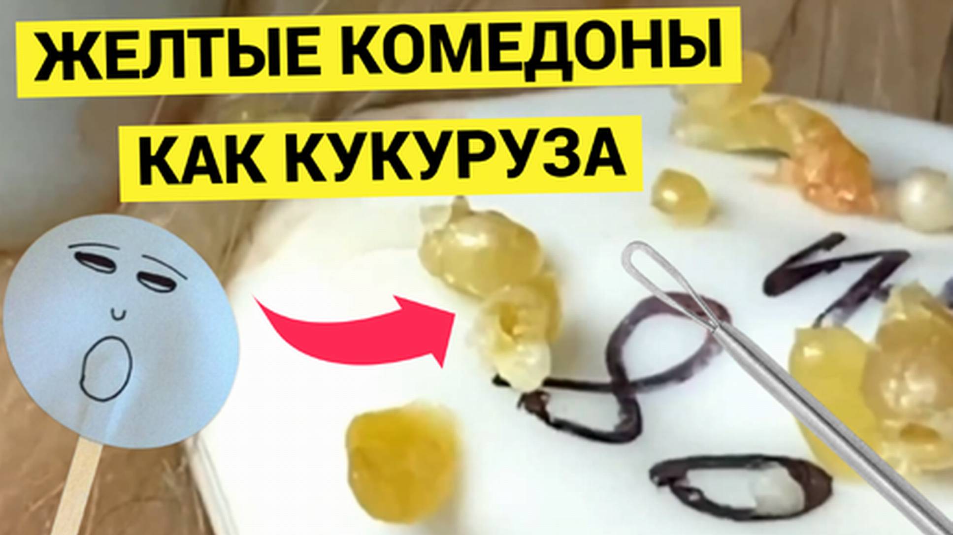 Желтые как КУКУРУЗА Комедоны и Жировики Пришлось Выдавливать Мастеру не без Труда. Зачем так тянула