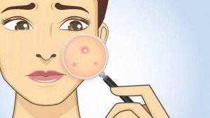 Прыщи и угри на коже. Как избавиться?