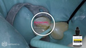 #Optibond application to occlusial surfaces of tooth  13, 14 #rubberdamology