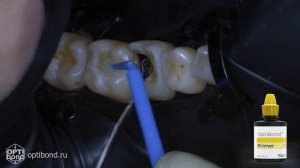 #Optibond application to occlusial surfaces of tooth  46, 47 #blackrubberdam #rubberdamology