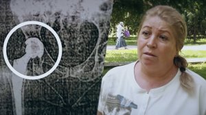 Пациентка отсудила у медиков 2,5 миллиона за удлинение ноги после операции