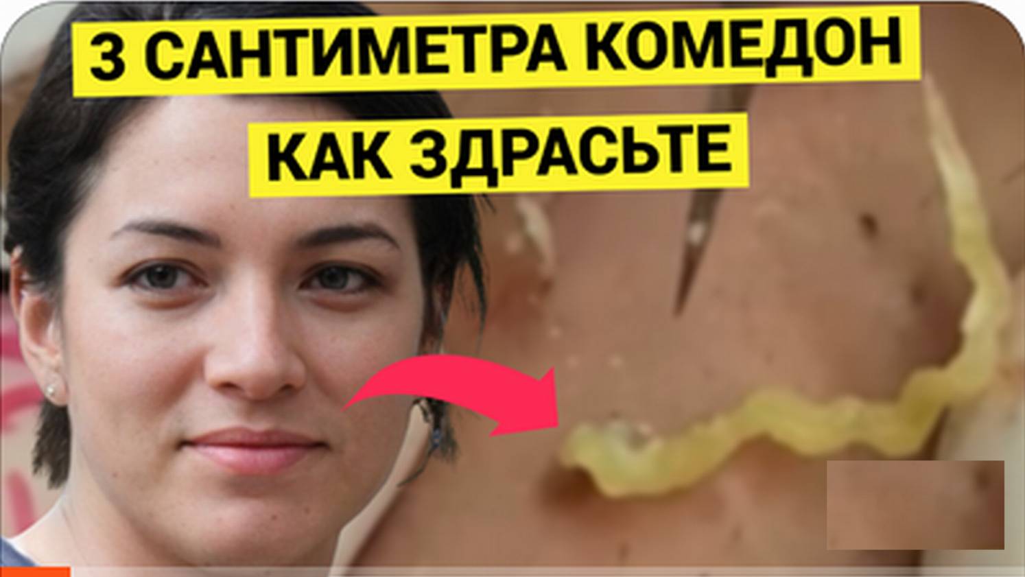 Крутой Косметолог Выдавливает Чётко БОМБОВЫЕ Комедоны и Угри. Рекомендую позалипать