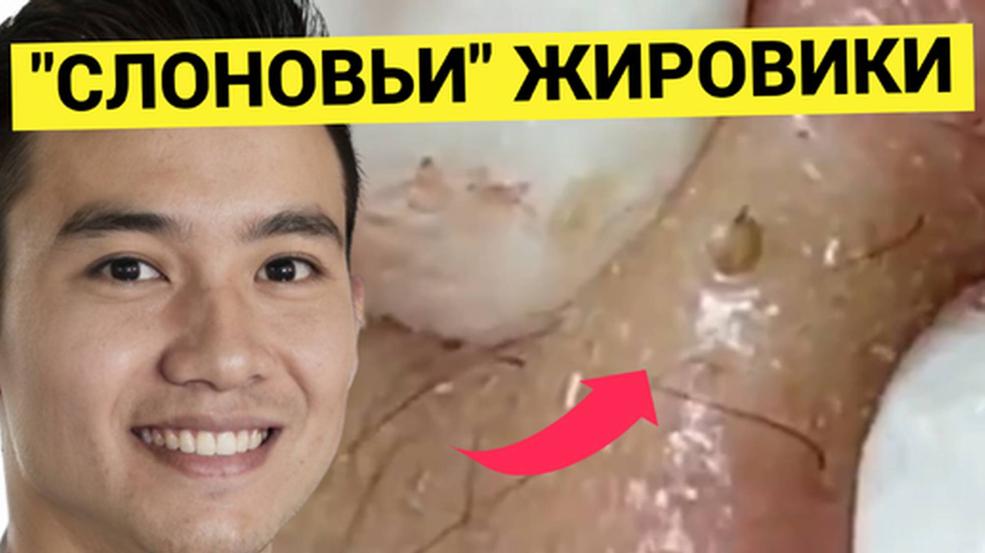 Кожа Жирная как у СЛОНА, Сальные Отложения Видны Снаружи