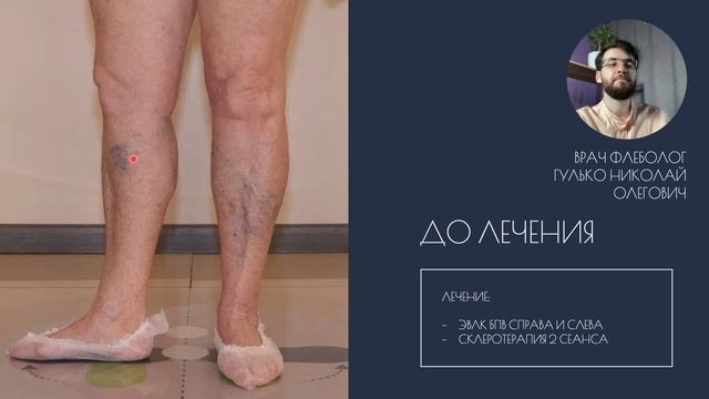 Вовремя не лечила варикоз, получила осложнение. Как не допустить? Флеболог Гулько Николай Олегович,