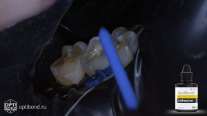 #Optibond application to occlusial surfaces of tooth 44, 45, 46, 47 #blackrubberdam #rubberdamology