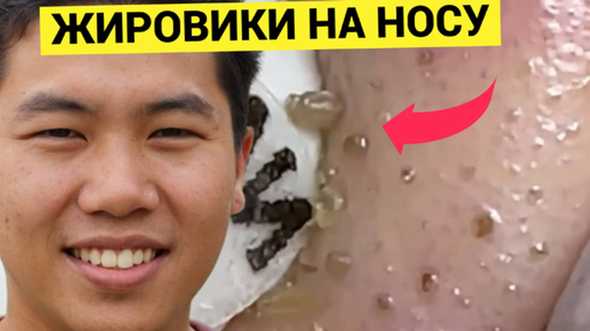 Как выдавить эти Жировики и Угри с носа - руками или инструментом_ Задача для косметолога. Справился