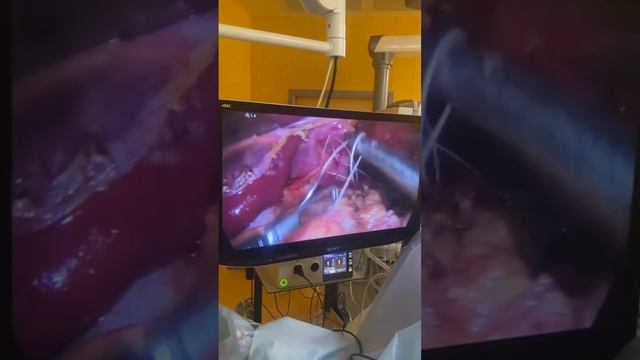 Грыжа пищеводного отверстия диафрагмы. Гастро-эзофагеальная рефлюксная болезнь.  #станиславцап