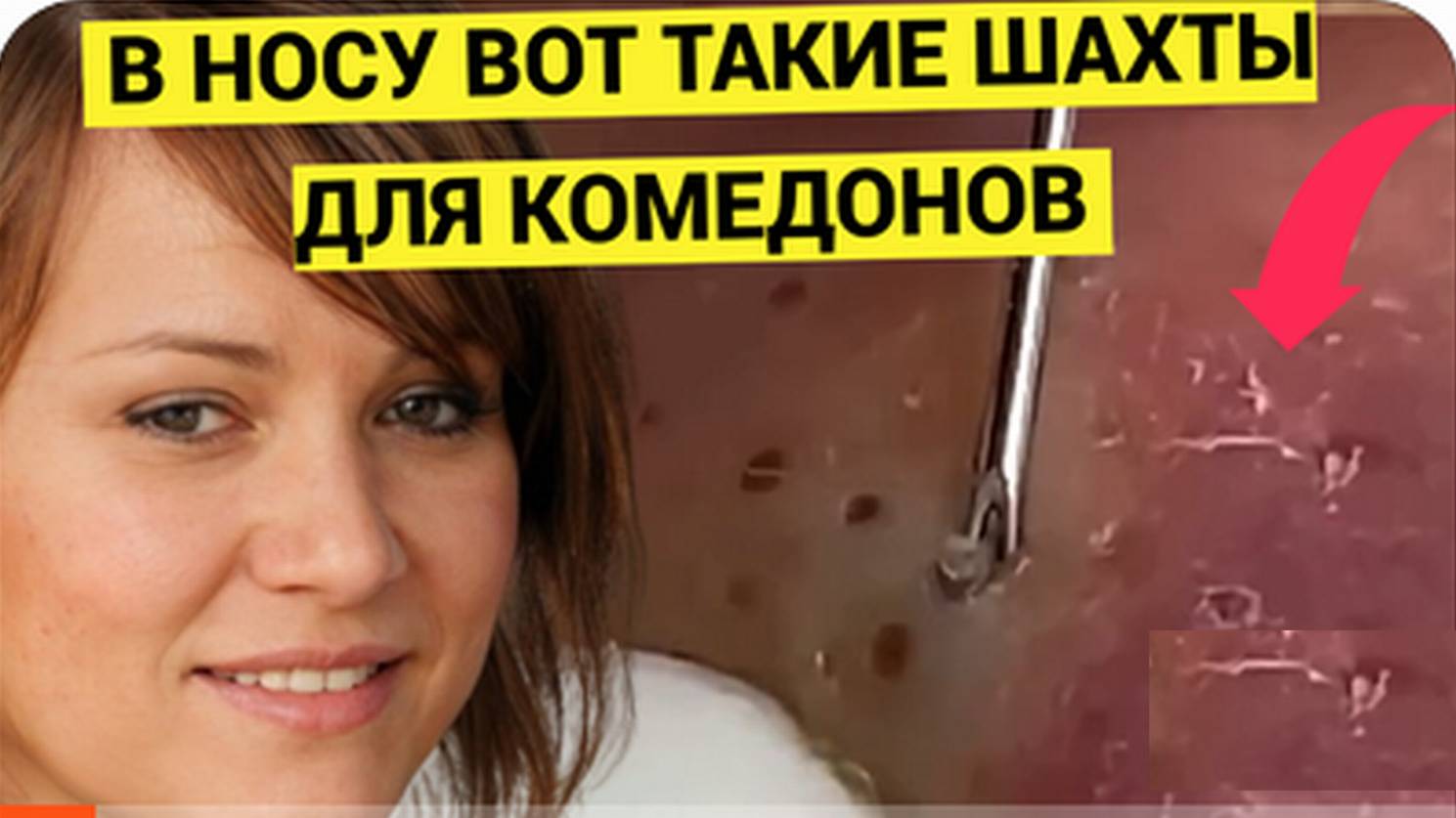 ШАХТЫ в Носу от Комедонов и Жировиков После Выдавливания. 7 Видов Прыщей у Этого Уникала
