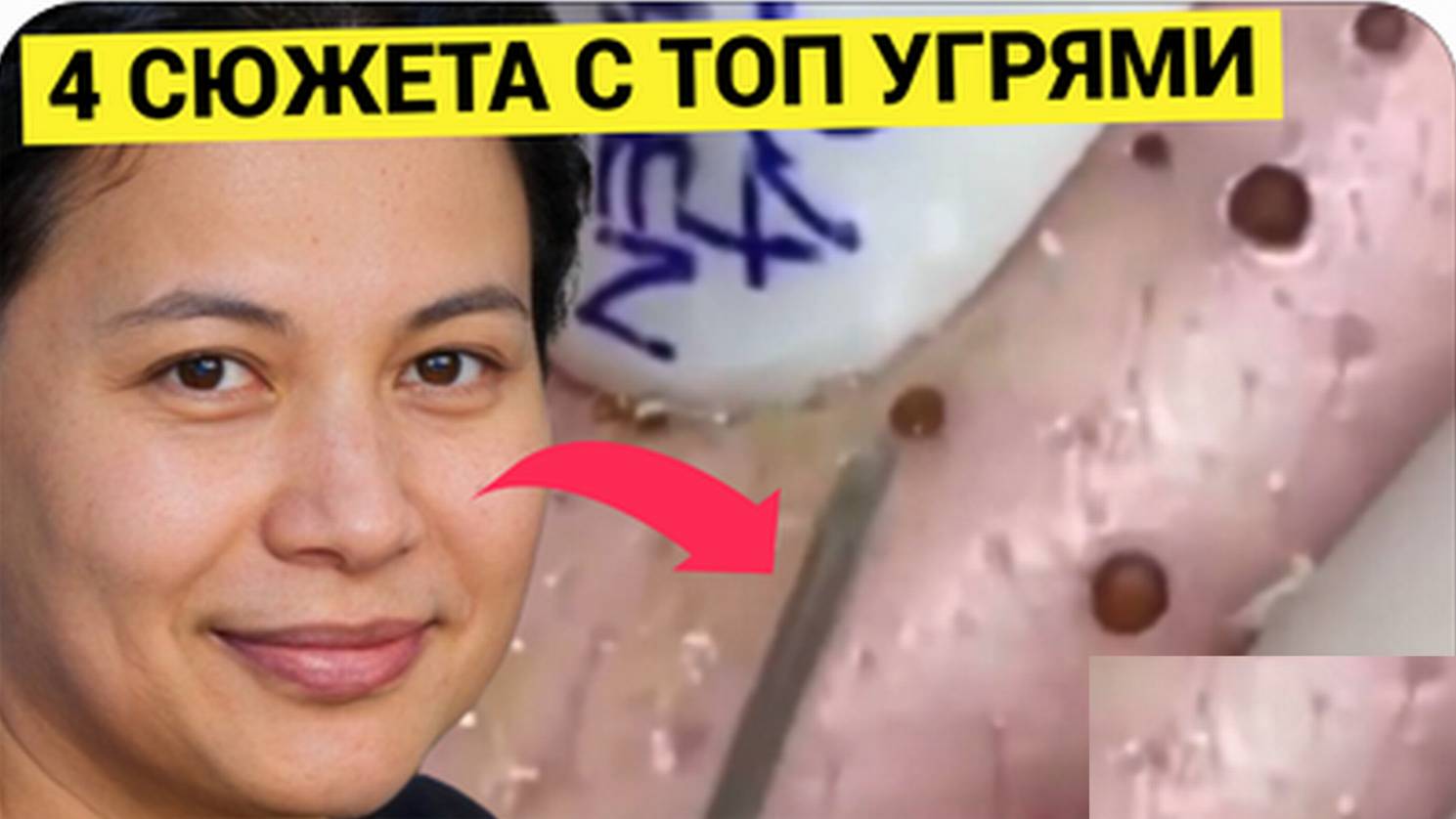 Сборник Жирнейших УГРЕЙ и Комедонов. Выдавливаются что Даже Не Верится. Как Живут с Такими Сантиметр