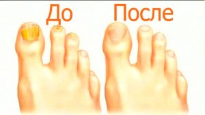Грибок ногтей ИСЧЕЗНЕТ навсегда! Простое средство за копейки – аптеки в шоке! Лечение!