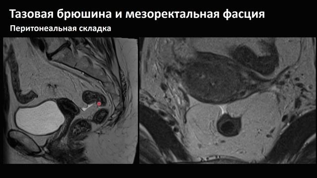 ЛД в онкологии. Часть 1 15.Лекция «Опухоли прямой кишки». Ле(1)
