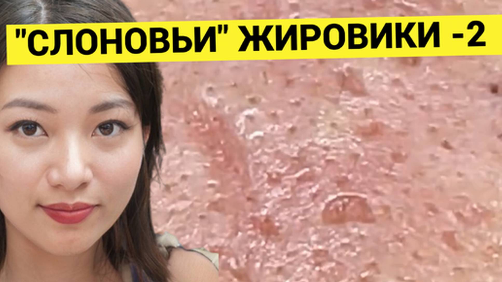 Поспал у Косметолога, Проснулся, а Жировиков Нет