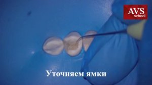 Композитная реставрация верхнего премоляра