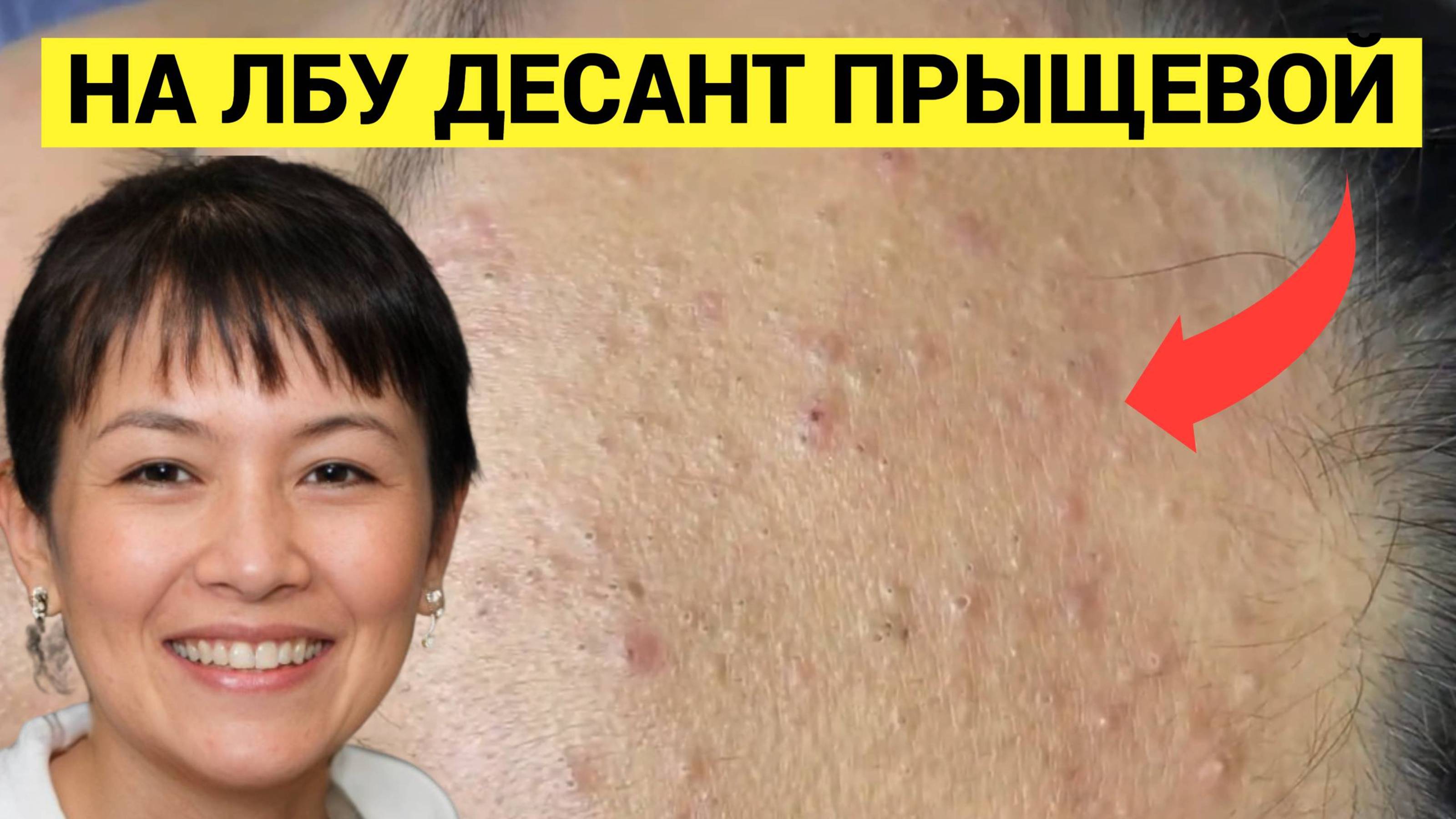 Высыпание Комедонов и Чёрных точек на Лбу у молоденькой девчушки. Косметолог показывает как распаков