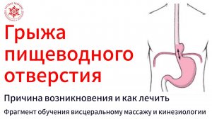 Грыжа пищеводного отверстия. Причина возникновения и как лечить. Фрагмент обучения