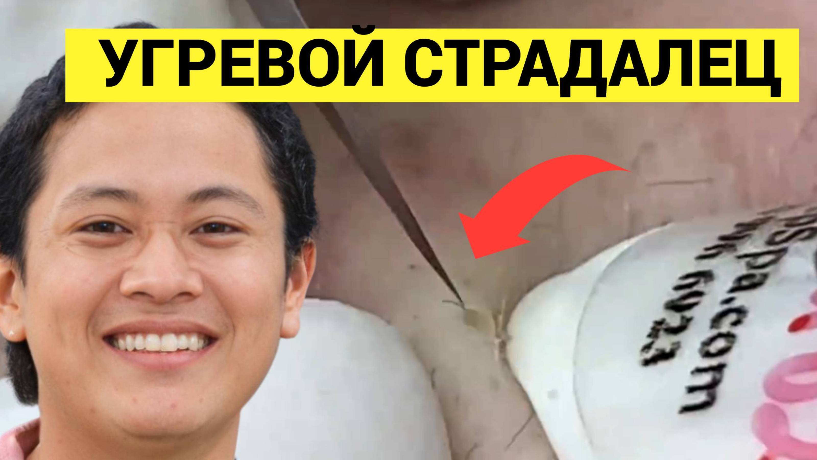 Акне и угревая сыпь выдавливаются у молодого парня. Косметологу пришлось приложить немалые усилия и