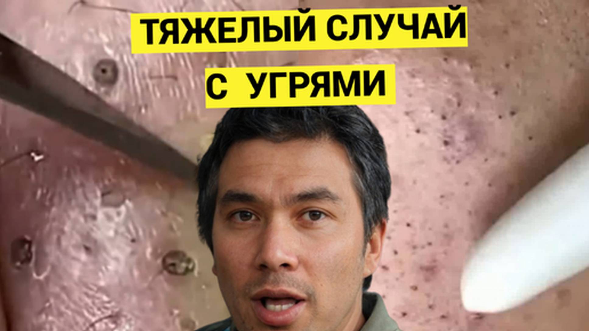 Угри и Жировики с Комедонами оказались Не подарок для Косметолога. Применил все инструменты, что был