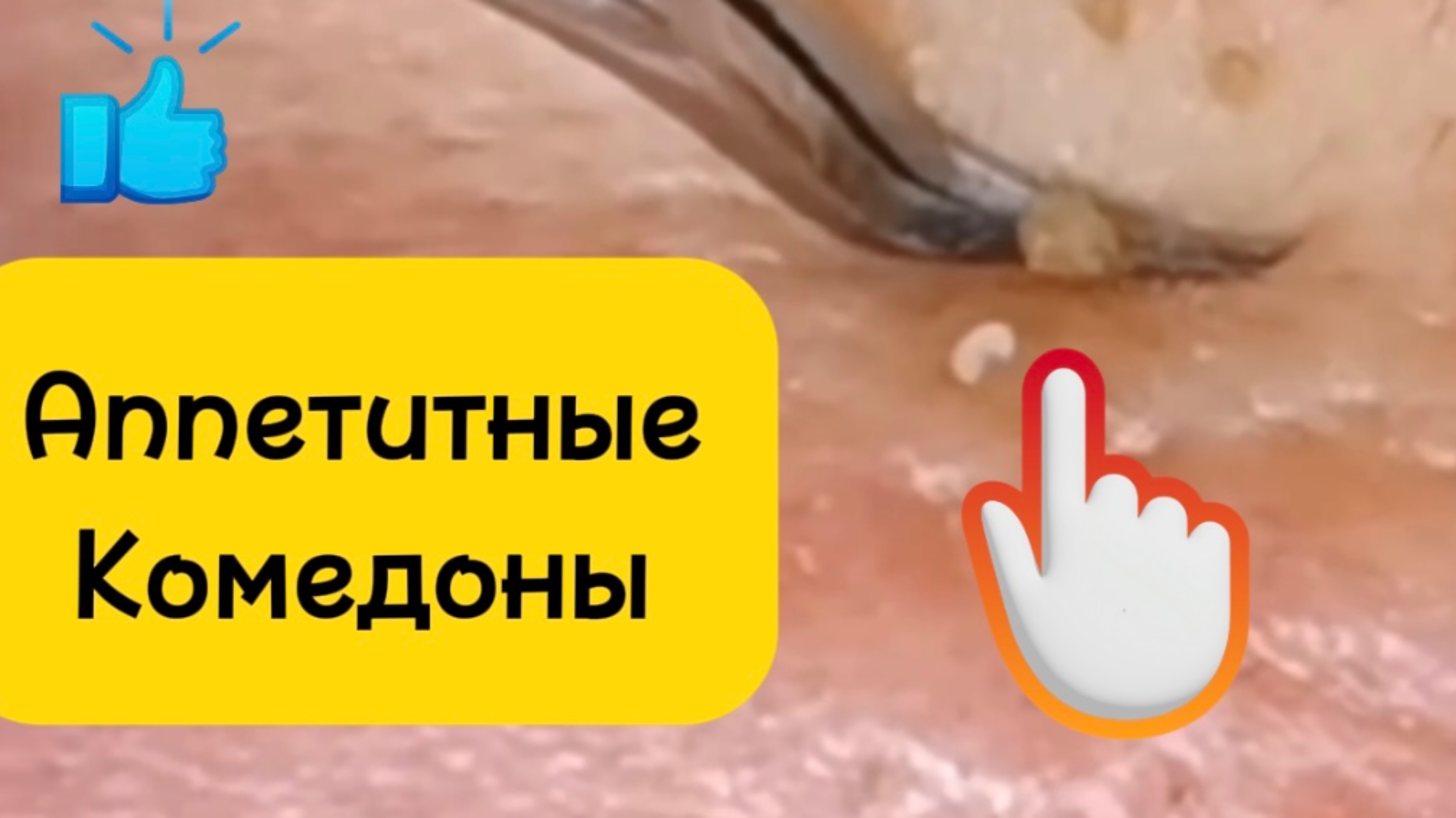 Очистка лица от угрей и акне.
Выдавливание прыщей. Удаление черных точек и комедонов.