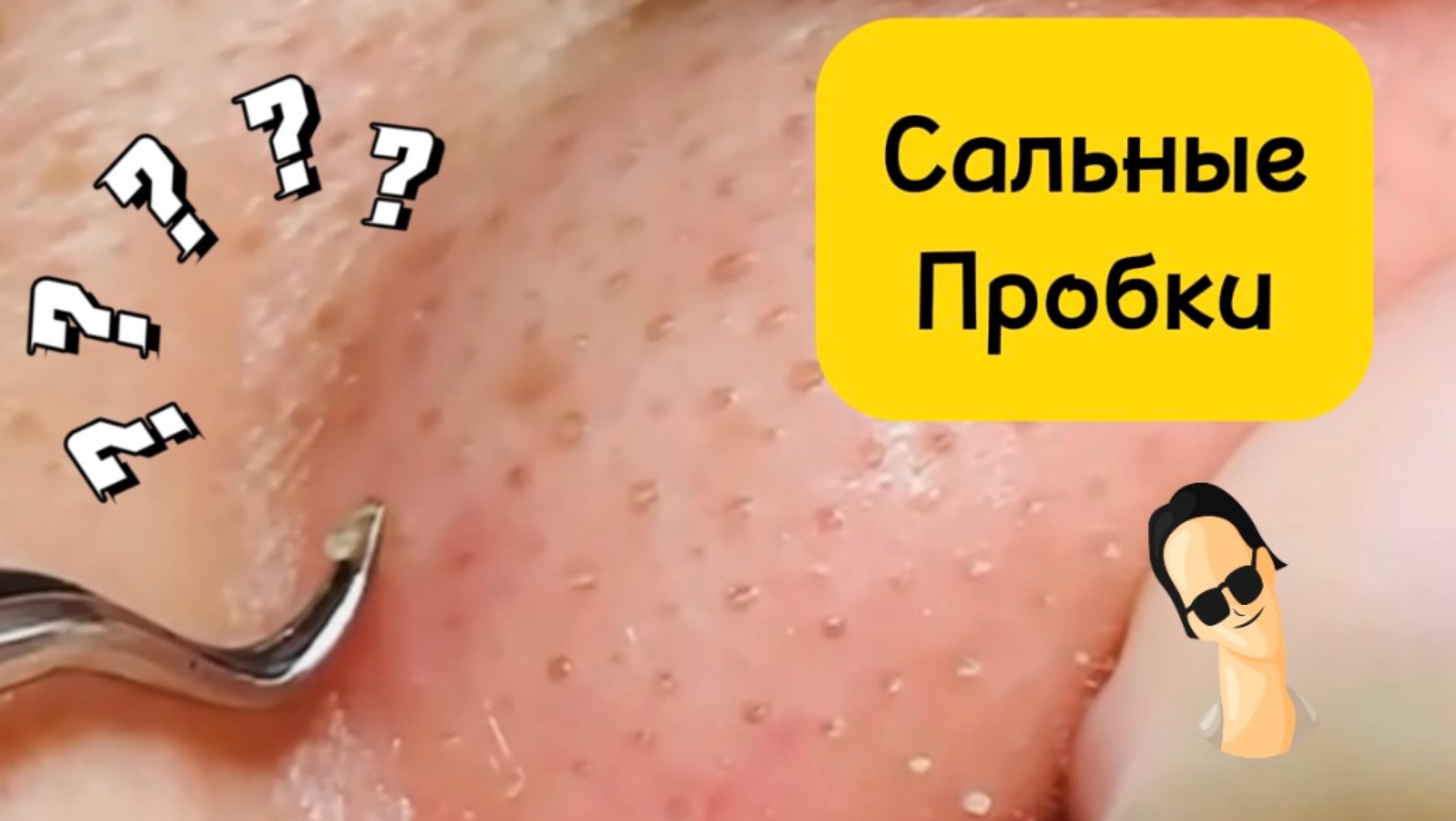 Очистка лица от угрей и акне.
Выдавливание прыщей. Удаление черных точек и комедонов.