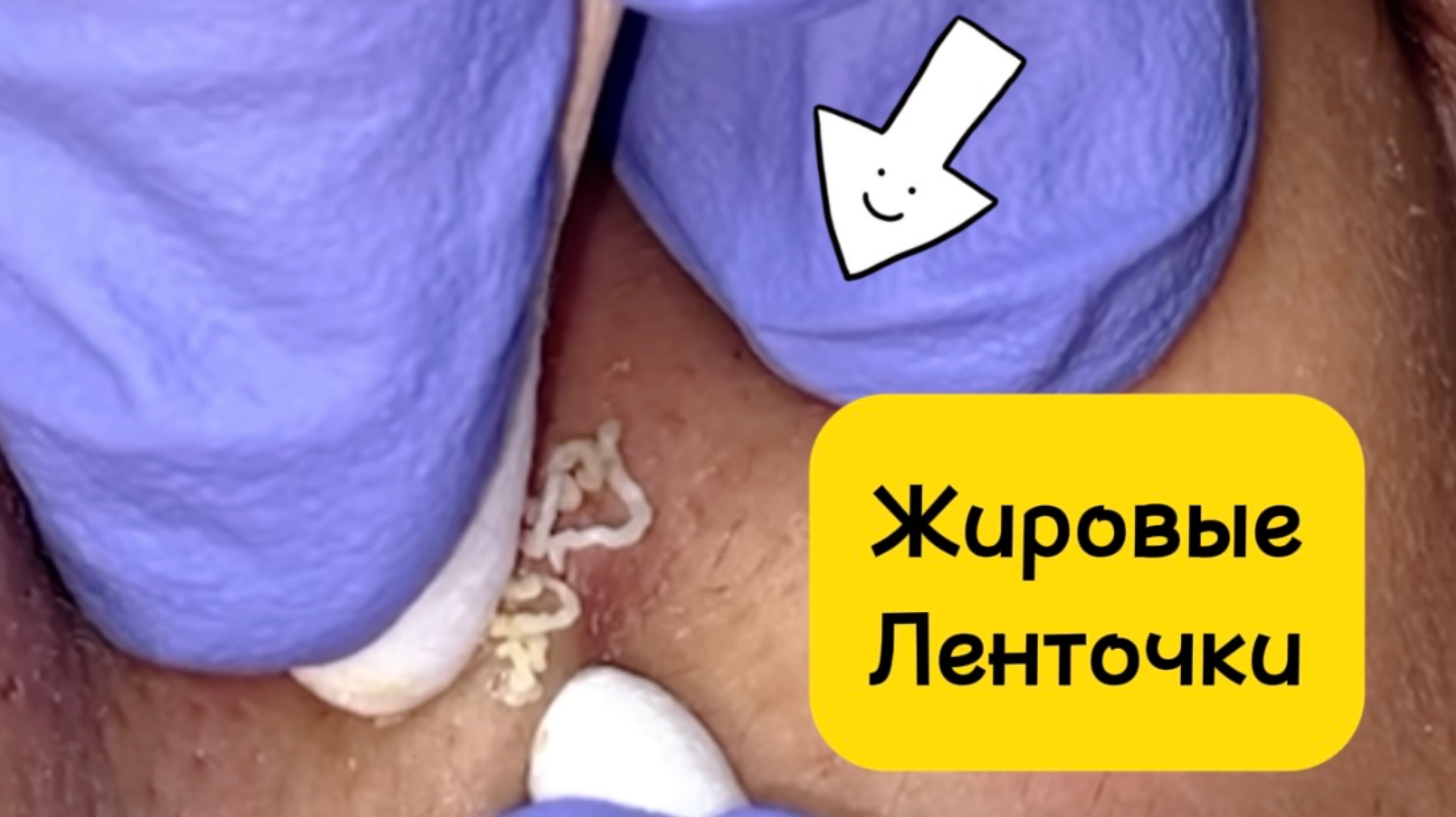 Очистка лица от угрей и акне.
Выдавливание прыщей. Удаление черных точек и комедонов.