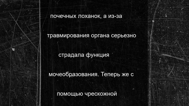 Урологи клиники при медуниверситете удалили крупный камень у жительницы Твери
