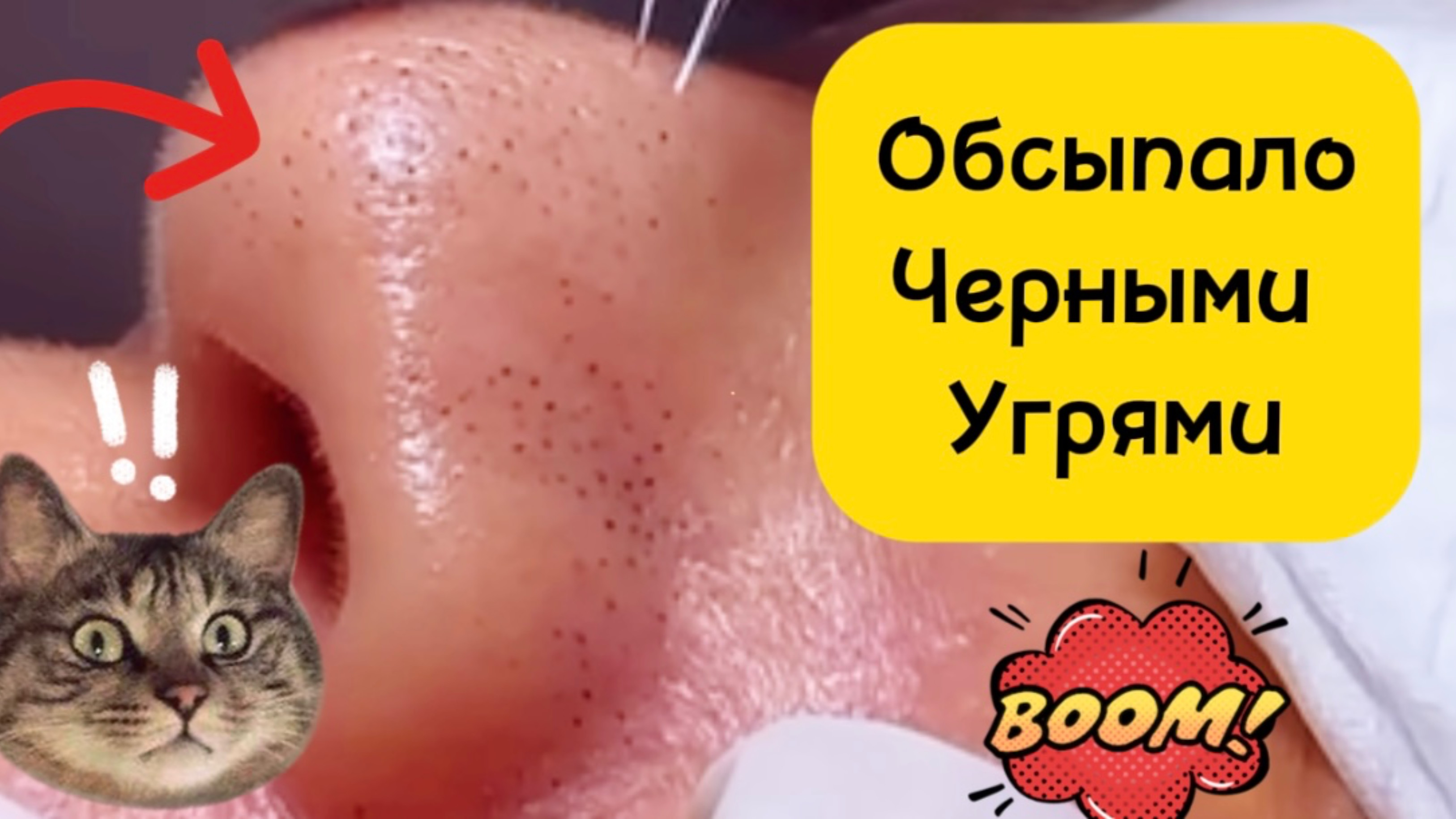 Очистка лица от угрей и акне.
Выдавливание прыщей. Удаление черных точек и комедонов.