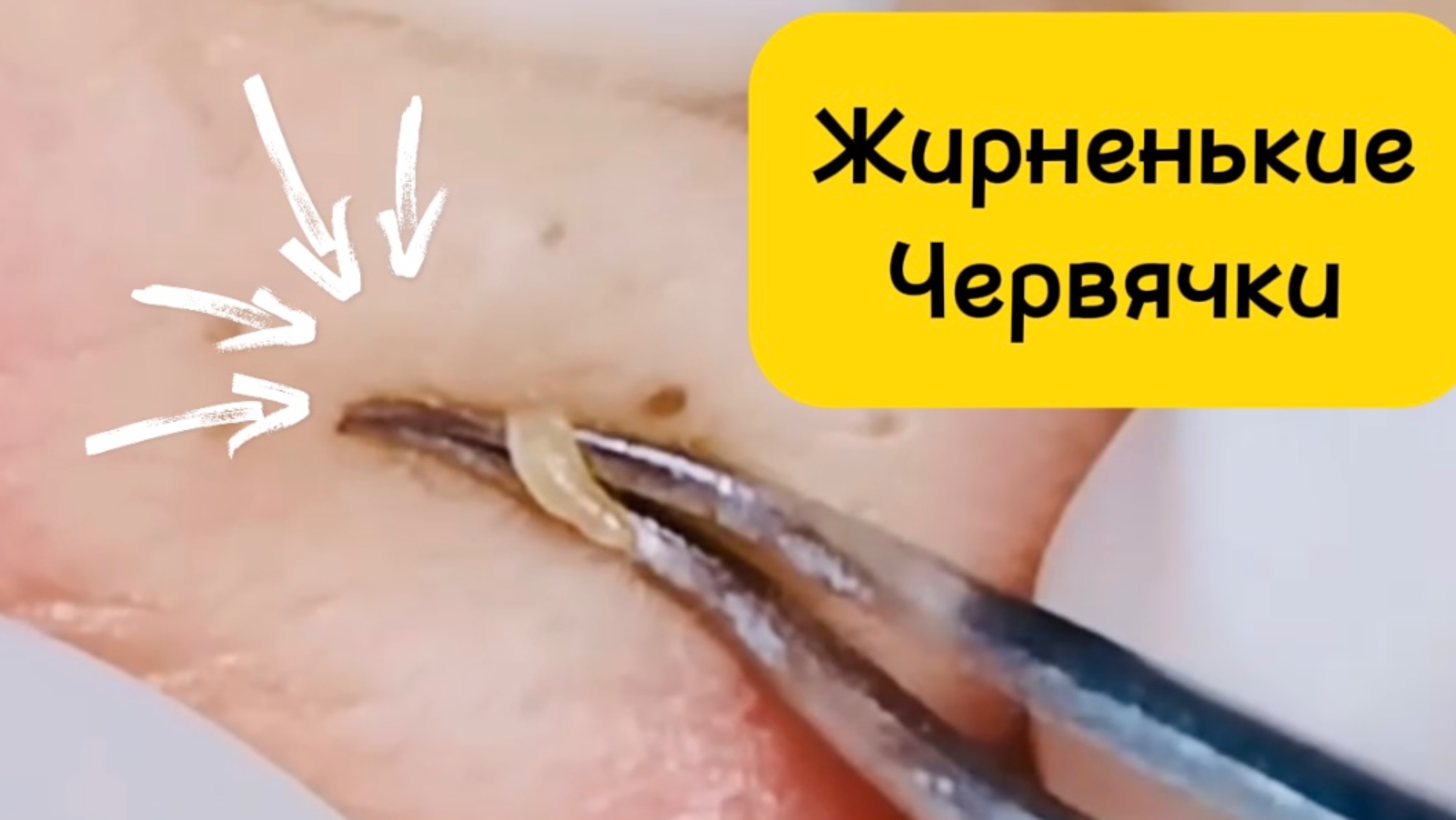Очистка лица от угрей и акне.
Выдавливание прыщей. Удаление черных точек и комедонов.