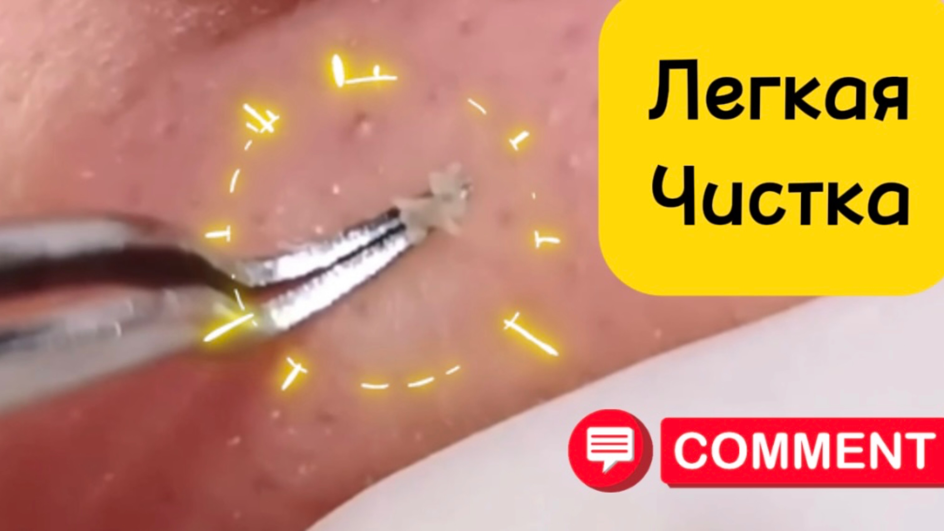Очистка лица от угрей и акне.
Выдавливание прыщей. Удаление черных точек и комедонов.