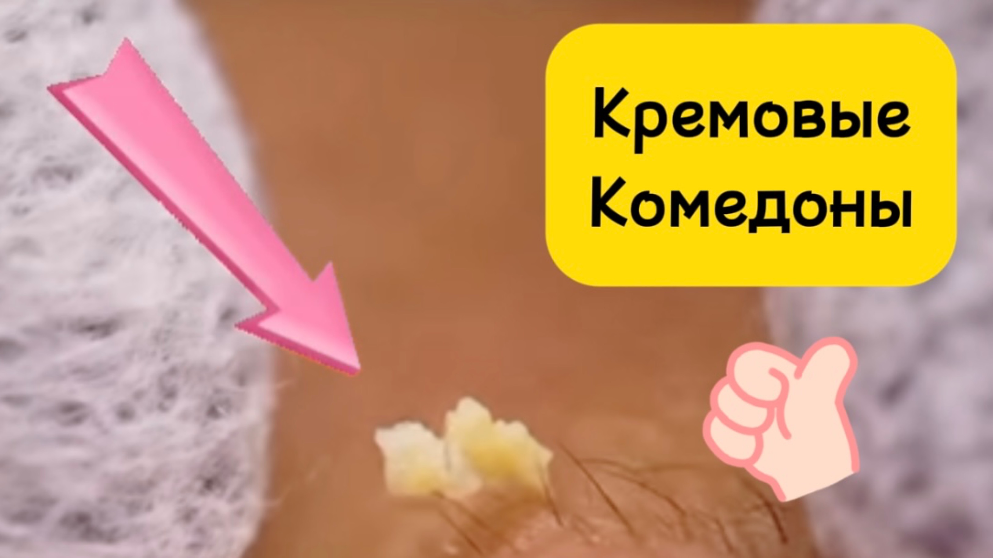 Очистка лица от угрей и акне.
Выдавливание прыщей. Удаление черных точек и комедонов.