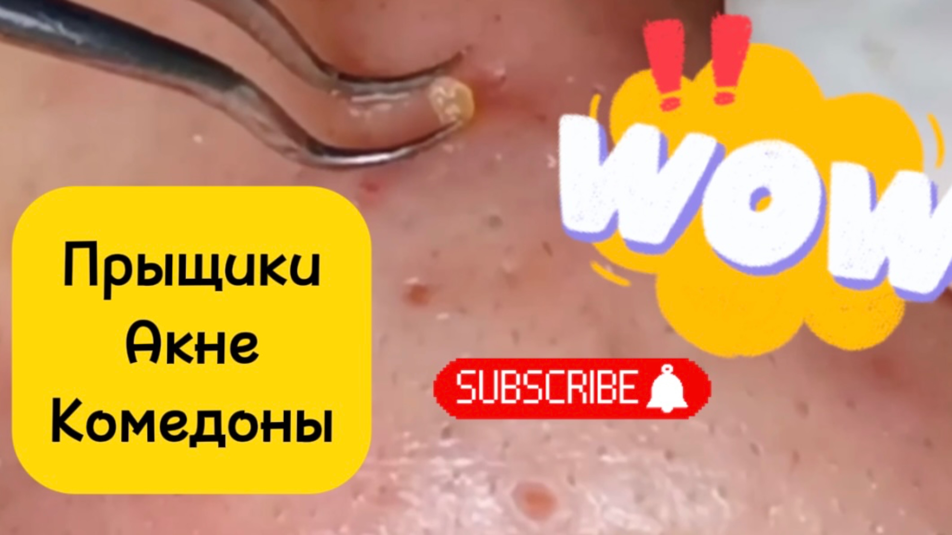 Очистка лица от угрей и акне.
Выдавливание прыщей. Удаление черных точек и комедонов.