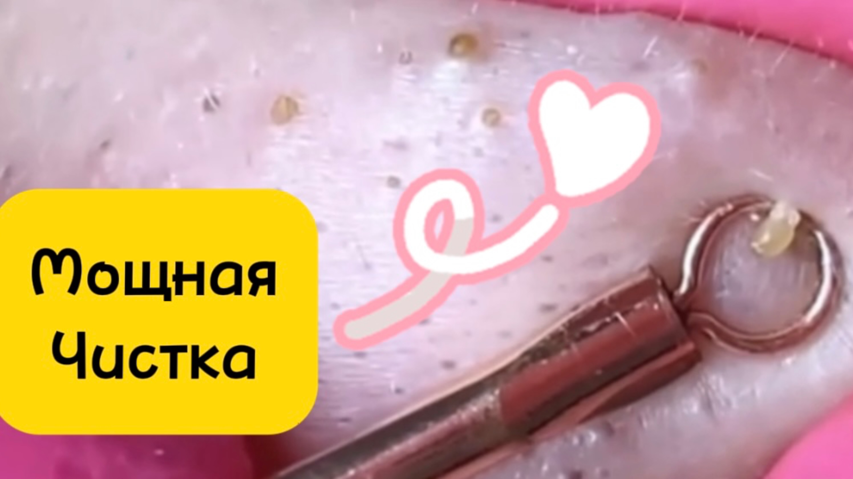 Очистка лица от угрей и акне.
Выдавливание прыщей. Удаление черных точек и комедонов.