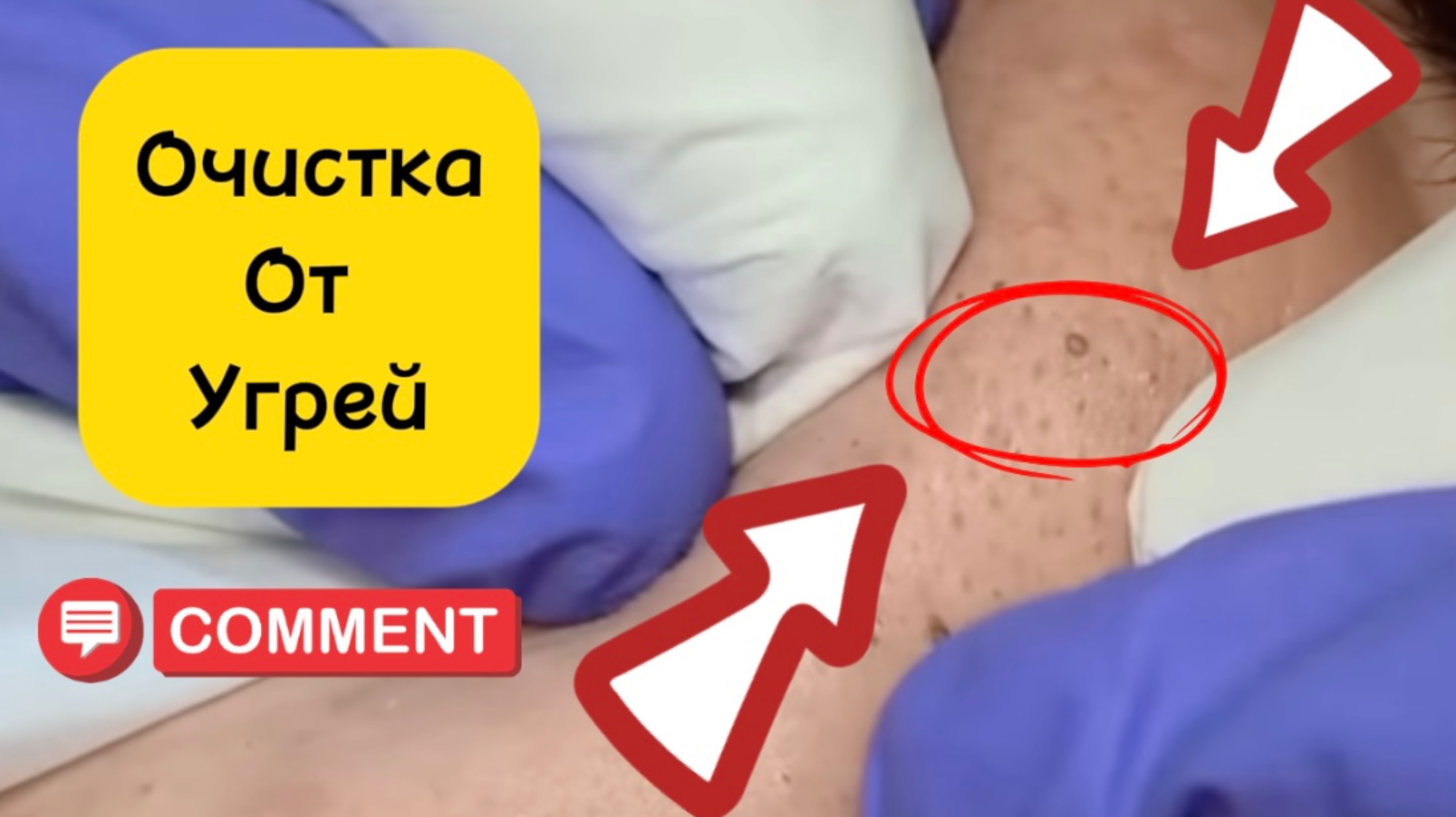 Чистка лица. Прыщи и черные точки
Очистка лица от угрей и акне.
Выдавливание прыщей. Удаление черных