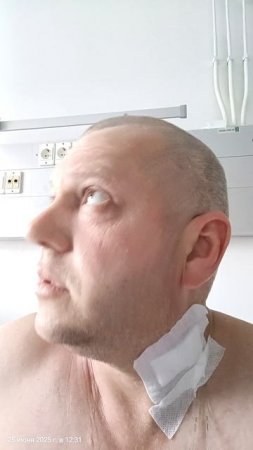 Сегодня последний день химии. Завтра отдыхаю на физрастворе. В пятницу трансплантация!mp4