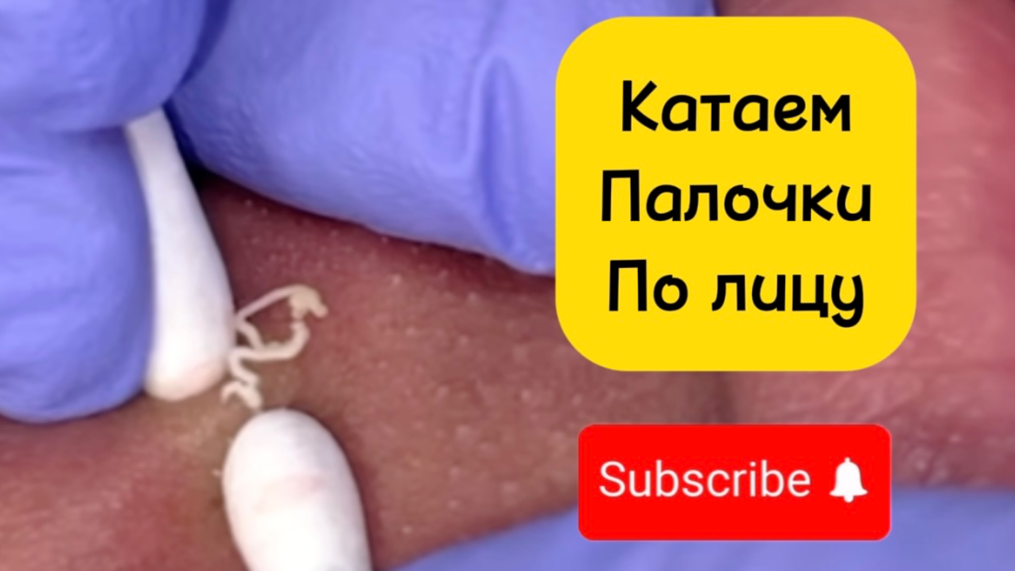 Очистка лица от угрей и акне.
Выдавливание прыщей. Удаление черных точек и комедонов.