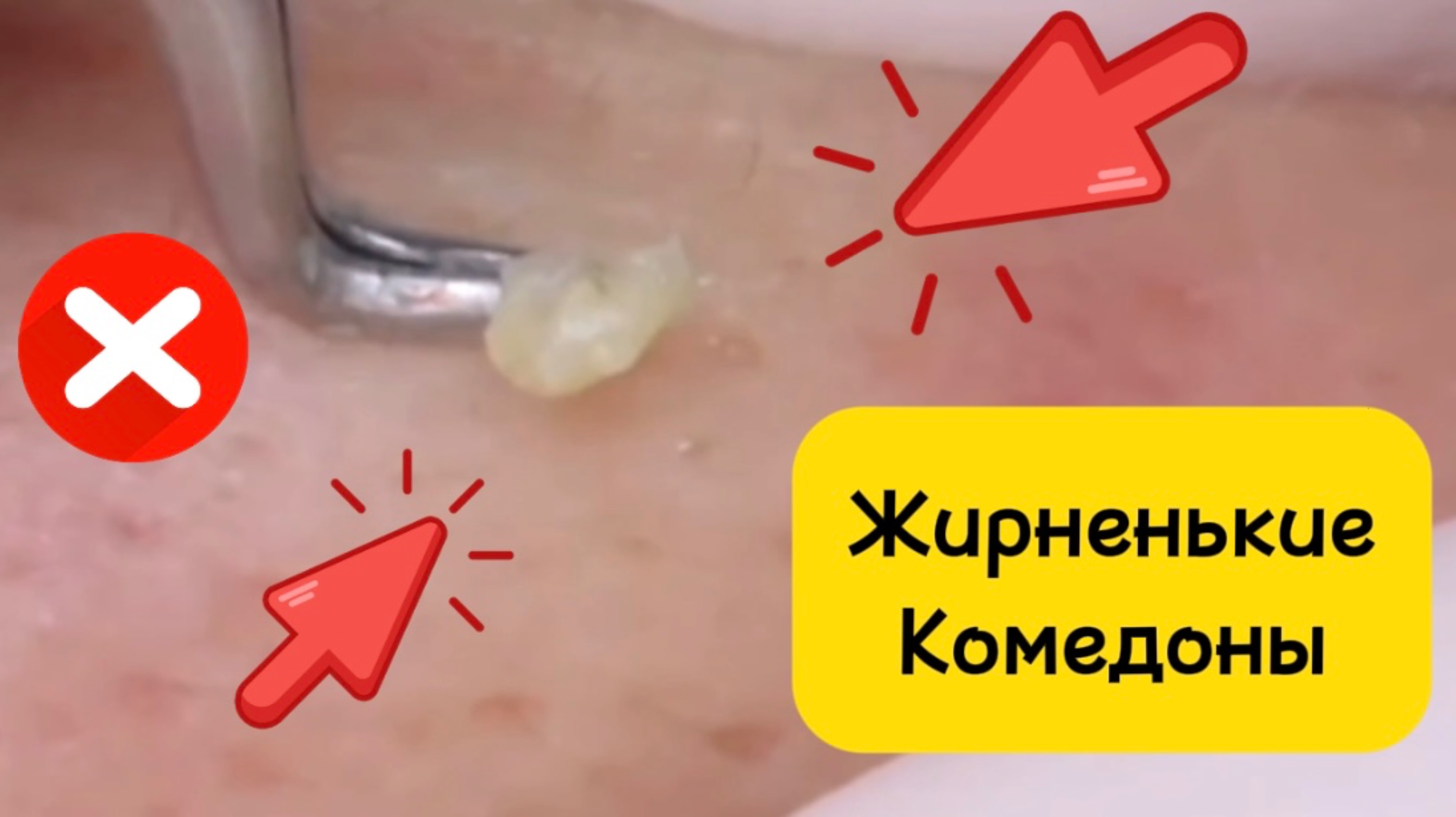 Очистка лица от угрей и акне.
Выдавливание прыщей. Удаление черных точек и комедонов.