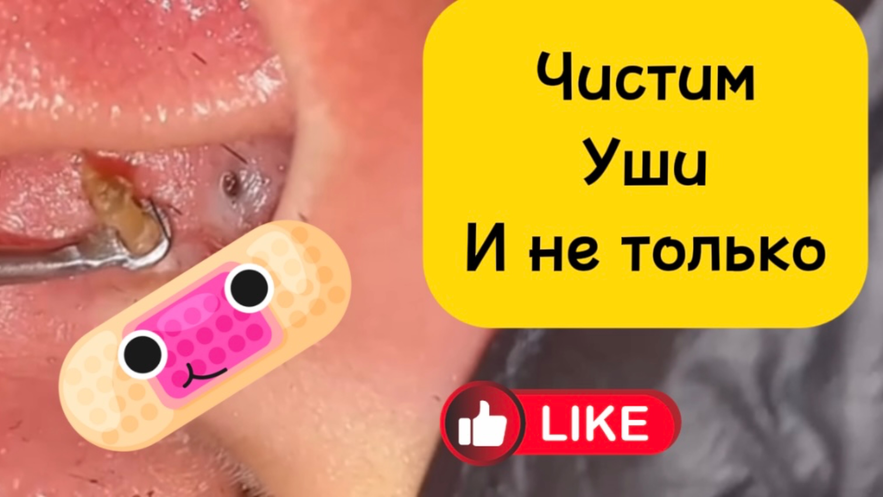 Очистка лица от угрей и акне.
Выдавливание прыщей. Удаление черных точек и комедонов.