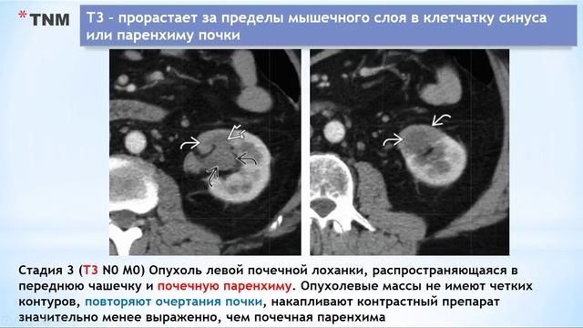 ЛД в онкологии. Часть 2 5. Лекция «Опухоли верхних мочевывод(1)