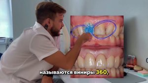 Установка виниров. КЕЙС