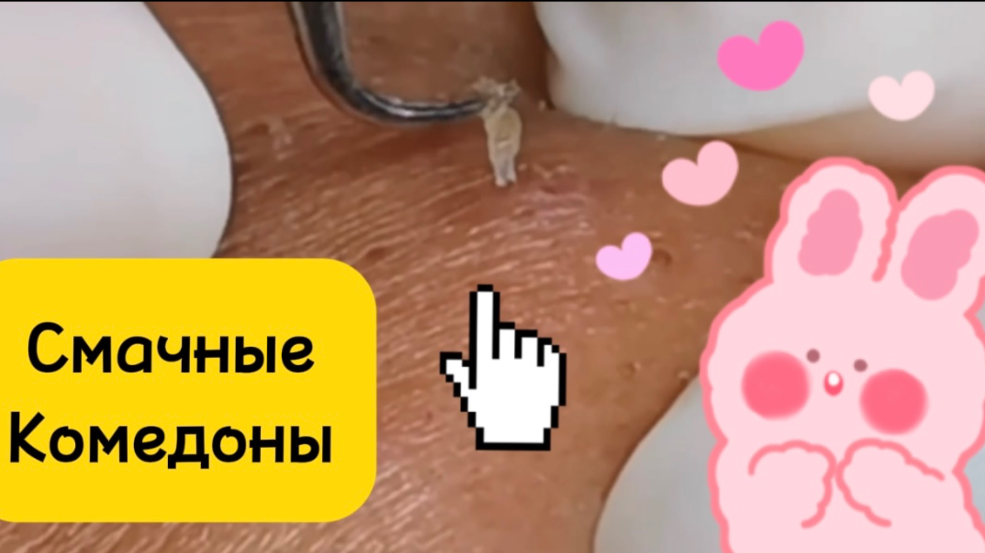 Очистка лица от угрей и акне.
Выдавливание прыщей. Удаление черных точек и комедонов.