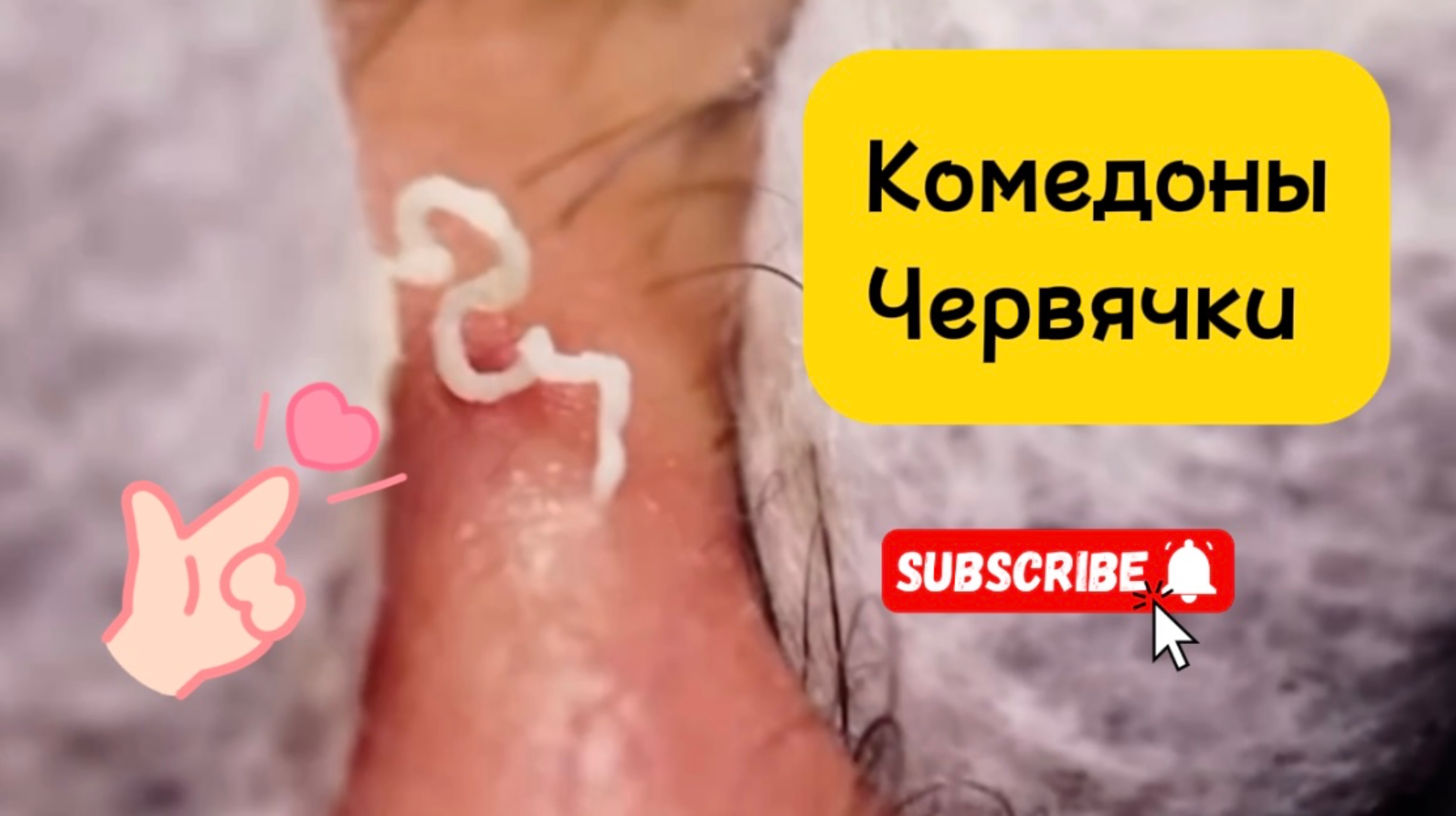 Очистка лица от угрей и акне.
Выдавливание прыщей. Удаление черных точек и комедонов.