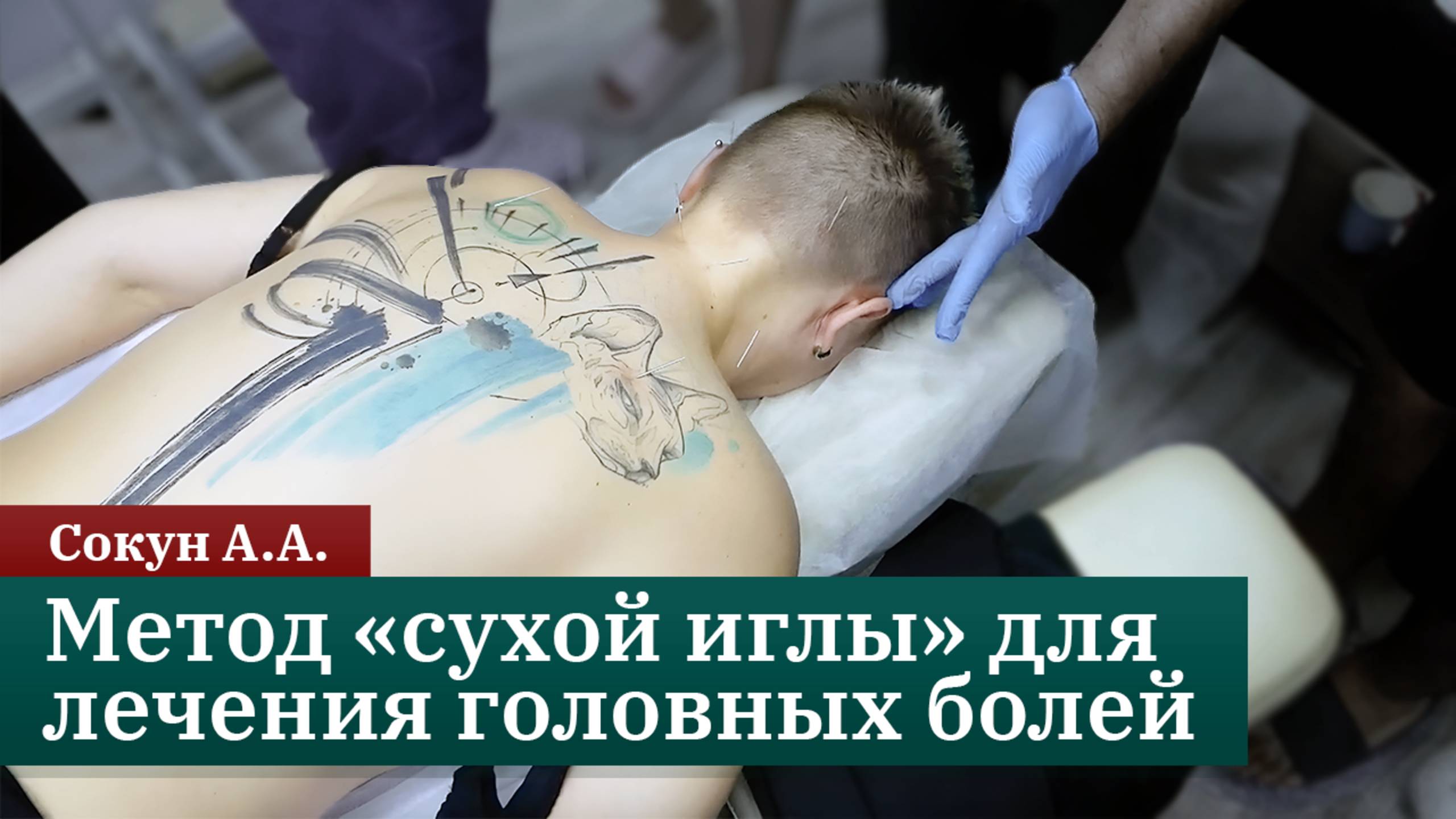Метод «сухой иглы» для лечения головных болей и невралгии. Сокун А.А.