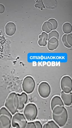 Стафилококк в крови под микроскопом. Семейный доктор Алена Братишко