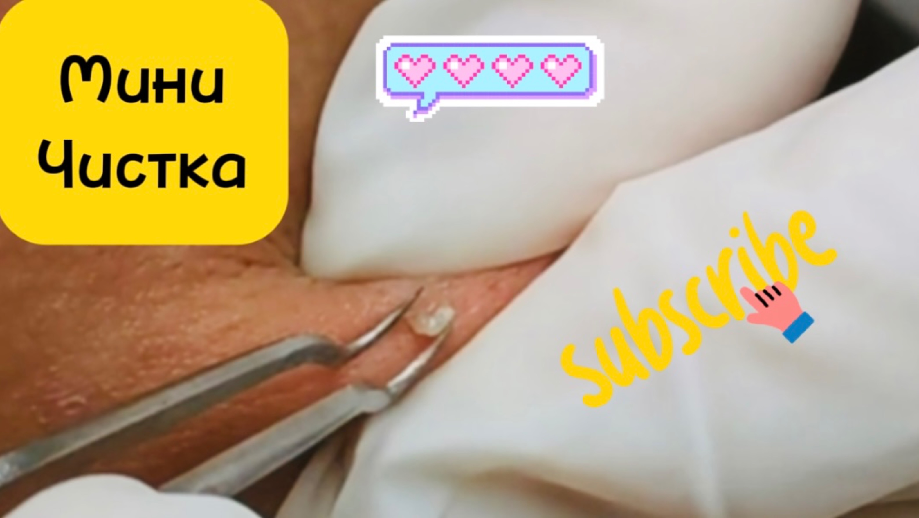 Очистка лица от угрей и акне.
Выдавливание прыщей. Удаление черных точек и комедонов.