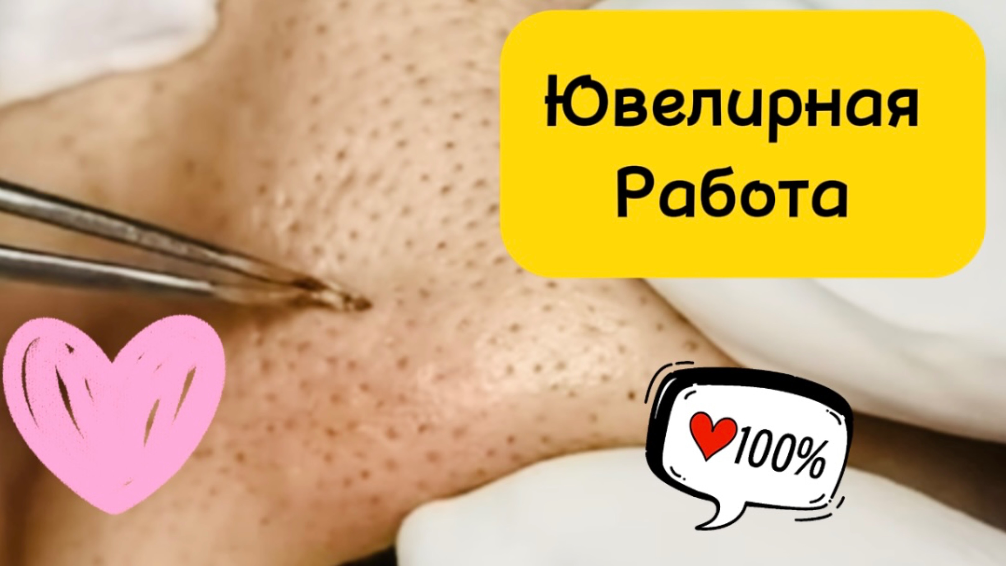 Очистка лица от угрей и акне.
Выдавливание прыщей. Удаление черных точек и комедонов.