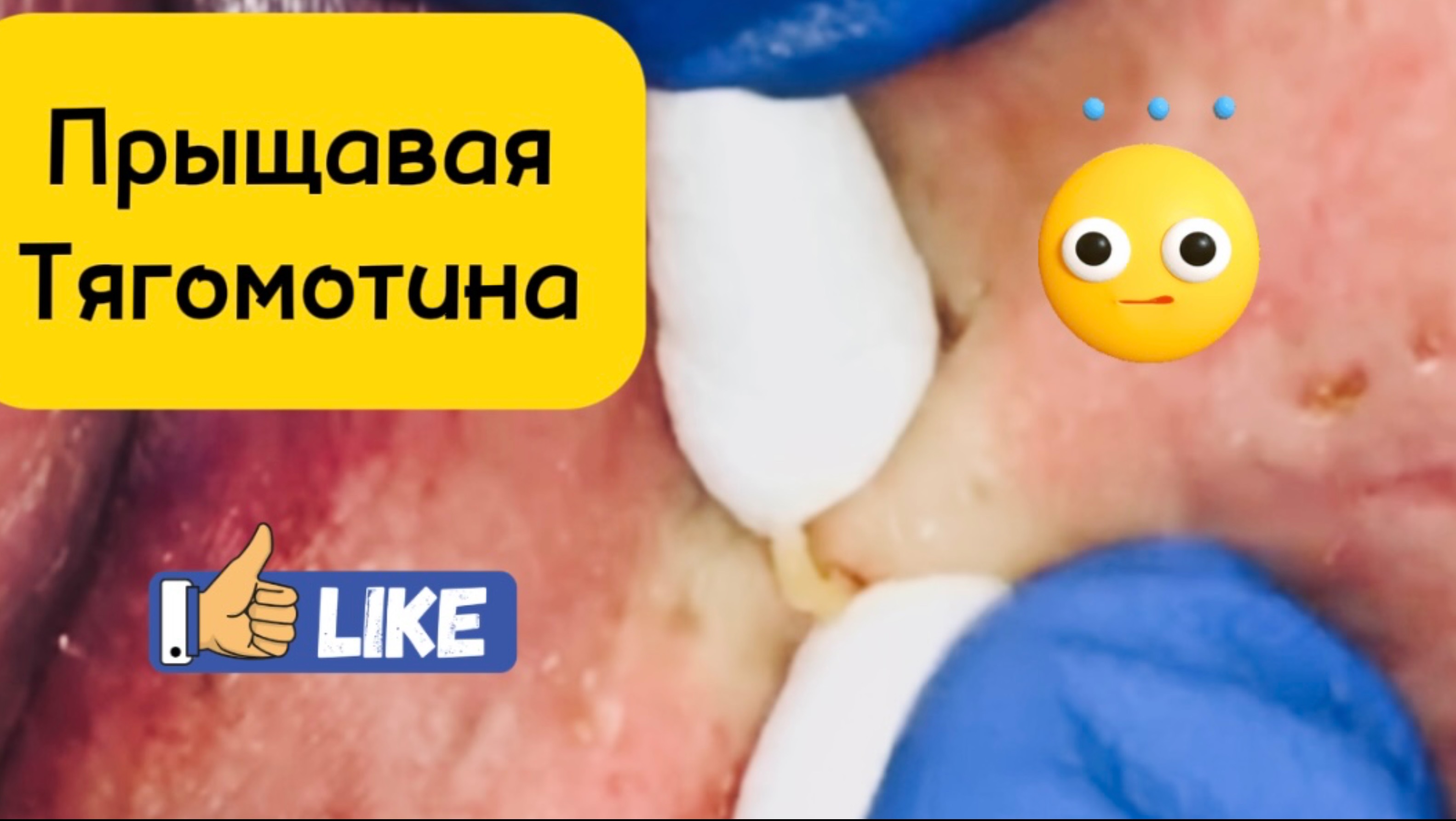Очистка лица от угрей и акне.
Выдавливание прыщей. Удаление черных точек и комедонов.