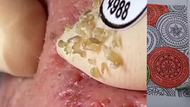 Жирные сальные пробки
